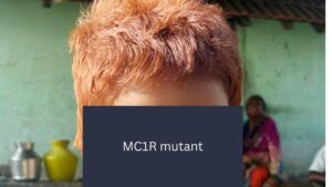 CCMB scientists identify rare gene behind Indian girl’s red hair
