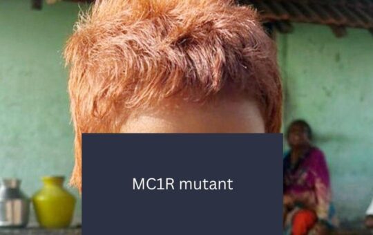 CCMB scientists identify rare gene behind Indian girl’s red hair