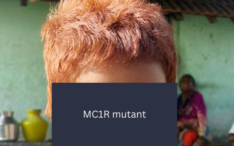 CCMB scientists identify rare gene behind Indian girl’s red hair