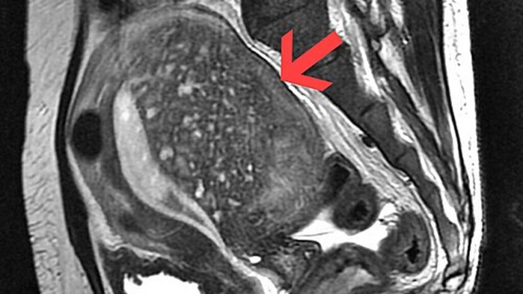 All you need to know about: adenomyosis