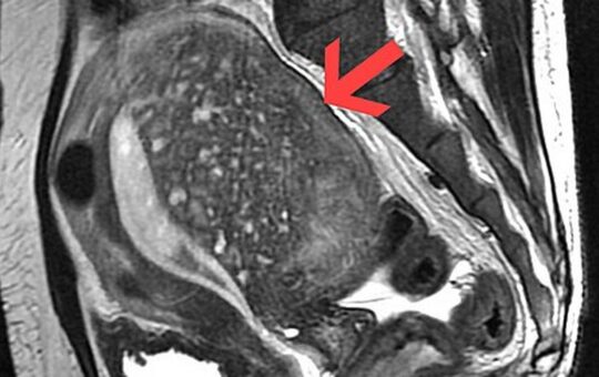 All you need to know about: adenomyosis